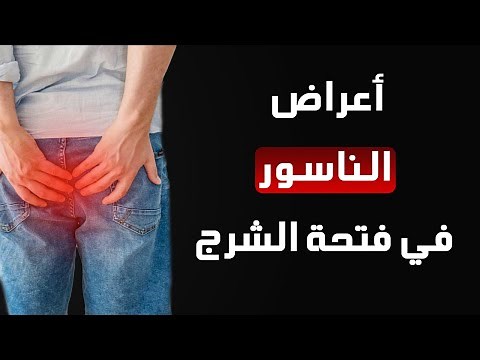 أعراض الناسور في فتحة الشرج وطرق العلاج