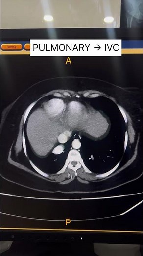 PAPVR with Dextrocardia CT Scan Explained #shorts