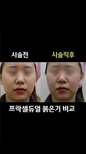 어븀에어셀 3단계 프락셀듀얼 레이저 후기 시술전후 붉은기 비교