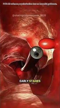 Colonoscopy Procedure!!3D Animation