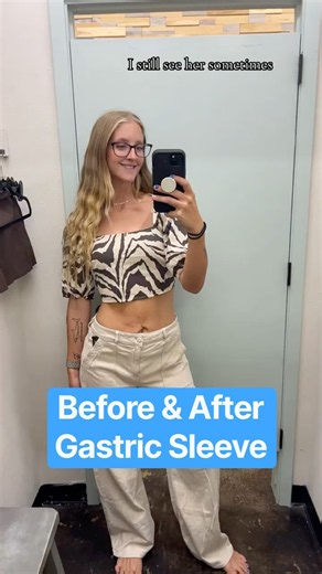 Before and After Gastric Sleeve 💞