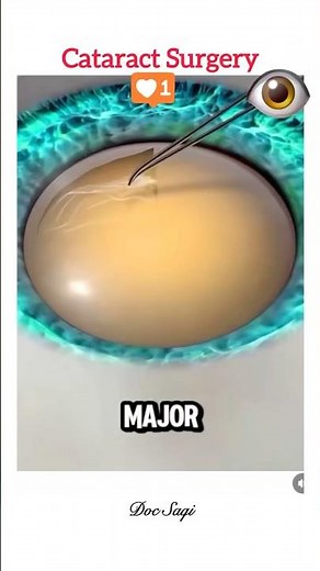 Cataract Surgery Procedure| #cataract #healthcare #cataracttreatment #shorts #medical