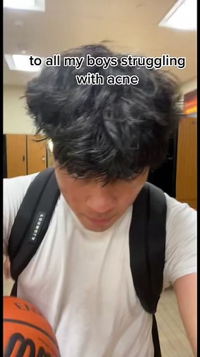 Men's Acne Tips and Accutane Journey