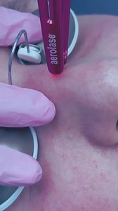 Zapping away spider veins 🕷️ Neo Elite® by Aerolase targets hemoglobin helping to reduce redness and the appearance of facial veins. 📷: @becca_smileworks | Aerolase