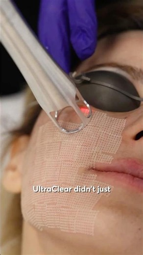 See Your Skin Transform with UltraClear Laser #lasertreatment