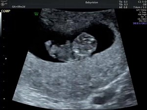 11K views · 54 reactions | Dating/reassurance scans are available from 6 weeks to 16 weeks. The images you will see will depend on how many weeks you are. This baby is 9 weeks and 2 days and was very active during the scan! | Babyvision | Facebook