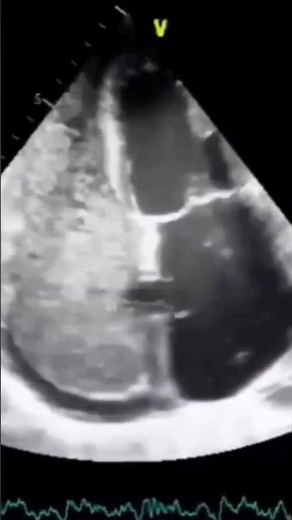 PFO/ASD or not?Bubble study