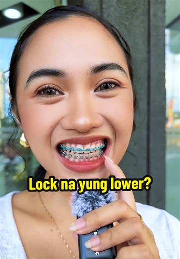 Braces Journey: Lower Teeth Locking Explained