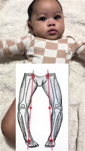 How to Care for Bow Legs in Babies