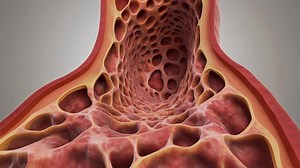 Download Medical 3D animation showing a cross section of a diseased bone with osteoporosis causing porous bone tissue and bone loss inside the body for free