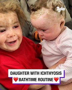15M views · 10K reactions | Daughter with Ichthyosis night time routine  | Tyla | Facebook