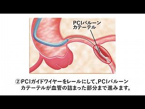 基本的なPCI治療の流れ