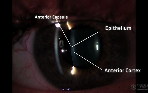 【中英双字】【裂隙灯晶状体检查】Slit Lamp Techniques Optical Section of Crystalline Lens