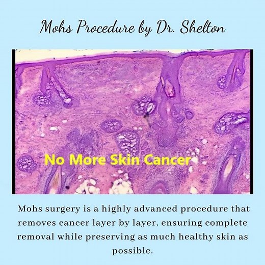 Mohs Surgery Explained | Expert Skin Cancer Treatment with Dr. Ron Shelton NYC