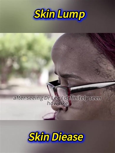 Effective Acne Treatment Techniques by Dr. Pimple Popper