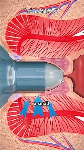 Stapled Haemorrhoidectomy using the PPH System (3D Animation)