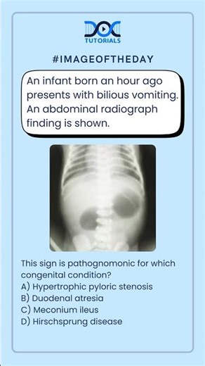👉 This sign is pathognomonic for which congenital condition?