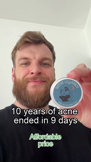 Sick of Acne? Fix it now and regain your confidence. | Norse Organics