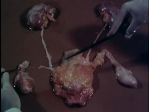 Autopsy Dissection Technique 1970s Film Post Mortem Examination Of Male Pelvic Organs And Kidneys : PARAMEDIA VIDEO : Free Download, Borrow, and Streaming : Internet Archive