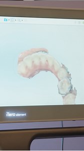 Digital Scanners Replacing Impressions