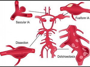 Dolichoectasia (dilation and elongation of arteries) ; Causes, Symptoms, Diagnosis, Treatment