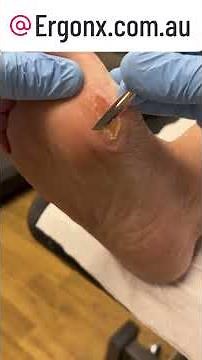 Satisfying Callus Removal by Podiatrist Using Scalpel #FootCare #Satisfying #Podiatry