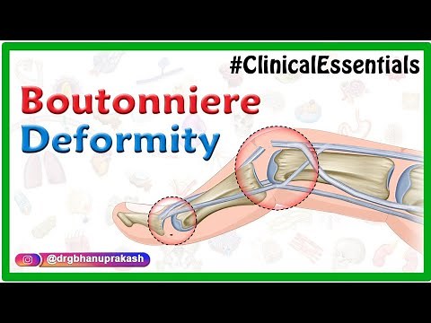 Boutonnière Deformity, Swan neck Deformity, Elson test, Mallet finger : Animated Clinical essentials
