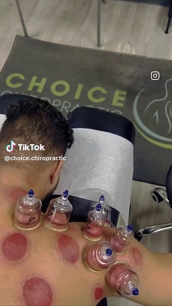 Dynamic movement while engaging in cupping therapy: Cups are placed along trigger points and adhesions while the doctor directs the patient to move through dynamic, specific movements in order move the tissue through common movements. This further increases the fluid that passes through the area in patterns that the tissue follows, helping to clear out inflammation, improve mobility, reduce tension, and help promote healing. Plus, they leave some nice marks after the cups are removed #chiropract