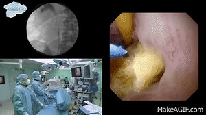 Flexible ureteroscopy and laser lithotripsy in ureter of an obstructing stone on Make a GIF