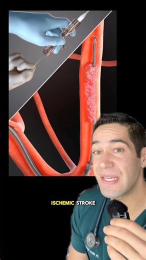 How doctors remove blood clots