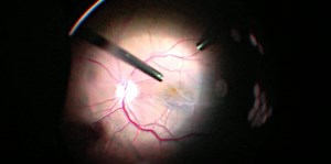 Advanced Surgical Management of Persistent Macular Pucker: Efficacy of the Double Peel Technique - Eyetube