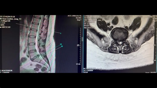 Effective Pain Management for L5/S1 Herniation Recovery