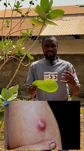 33K views · 724 reactions | How to treat stubborn boils away | Secrets Of Health TV | Facebook