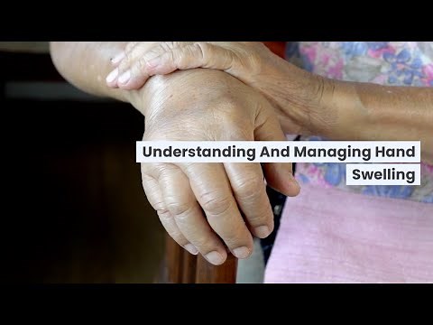 How to Deal with Hand Swelling: Understanding Causes and Solutions | BuoyHealth.com