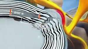 125K views · 503 reactions | A common back injury, lumbar disc...