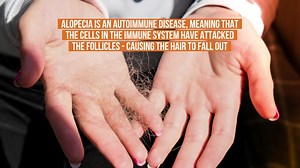 What is alopecia?