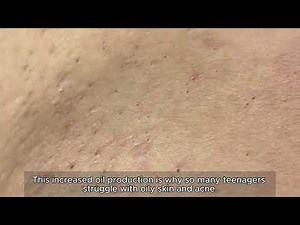 Blackhead removal with SAC DEP SPA | Satisfying and Relaxation with SAC DEP SPA #7895343