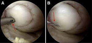 Arthroscopic Fixation of Knee Osteochondritis Dissecans With Interlinked Knotless All-Suture Anchors
