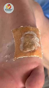 1.2M views · 6.6K reactions | How to Care for Your Nails and Keep Your Feet Comfortable #ingrownnail #ingrowntoenail #nails | Evgeniy | Facebook