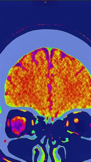 Mindless on Instagram: "the endless stream of hyper-stimulating clips, doomscrolling, algorithmic junk, and low-effort entertainment—trains your mind to crave constant novelty while destroying your ability to sustain attention. Every swipe delivers a tiny hit of dopamine, conditioning your brain to expect fast rewards with zero effort. Over time, this rewires your neural pathways: patience erodes, deep work becomes harder, and even simple tasks start feeling boring or “too much.” The mind gets s