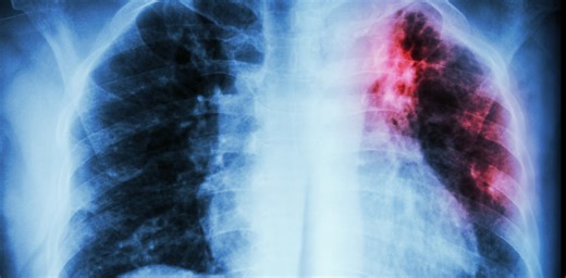 AI can help predict whether a patient will respond to specific tuberculosis treatments, paving way for personalized care