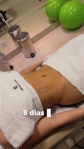 APENAS 8 DIAS DE PÓS! 😱 A definição inicial da Lipo HD Total Definer!