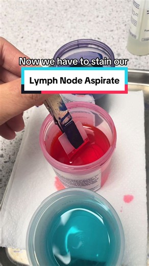 ✨Take a look at this aspirate from a canine lymph node! This patient presented for lethargy and it was found all the lymph nodes were swollen. A sample was obtained and stained with Diff-Quik stain. What is your suspect diagnosis? . . . #vetmed #veterinary #aspirate #cytology #lymphnode #microscope #vettech #vetvisit #vetclinic #veterinarymedicine #pathology #vetclinic #vetschool #clinicalpathology #veterinaria #veterinario #veterinaire