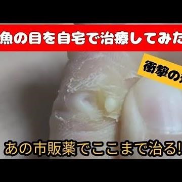 【衝撃】魚の目を自力で除去！市販アイテムでここまで治る！