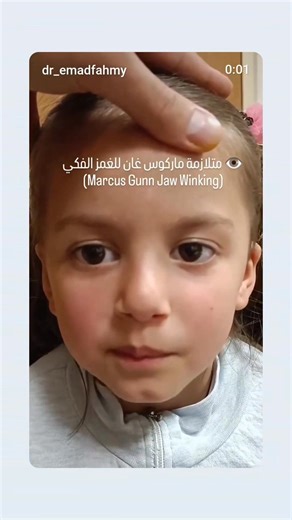 متلازمة ماركوس غان للغمز الفكي (Marcus Gunn Jaw Winking Syndrome). إليك شرح مفصل لهذه الحالة: 👁️ متلازمة ماركوس غان للغمز الفكي (Marcus Gunn Jaw Winking) هي حالة طبية نادرة وخلقية (يولد بها الطفل)، وتتميز بحدوث حركة غير طبيعية في الجفن العلوي للعين المصابة (غالباً عين واحدة) بالتزامن مع حركة الفك. ما الذي يحدث؟ * تدلي الجفن (Ptosis): في وضع الراحة، يكون الجفن العلوي للعين المصابة متدليًا قليلاً أو متوسطًا (تدلي الجفن الخلقي). * الغمز الفكي (Jaw Winking): عندما يقوم الشخص بحركة معينة بالفك، مثل 