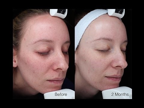 Skin Rejuvenation - What is SkinPen Micro-needling?