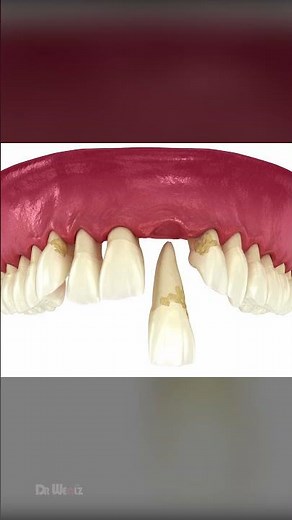 Why Do We Lose Teeth, Periodontitis Explained