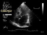 Infective Endocarditis:Chordal Rupture Of The Posterior Mitral Leaflet With Flail Mitral Valve • Video • MEDtube.net