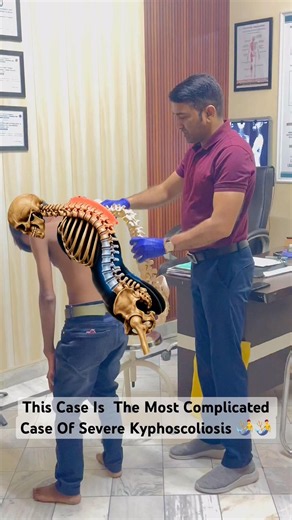 Severe Kyphoscoliosis case treatment by DrRavi #scoliosis #best #chiropractic #spine #hunchback