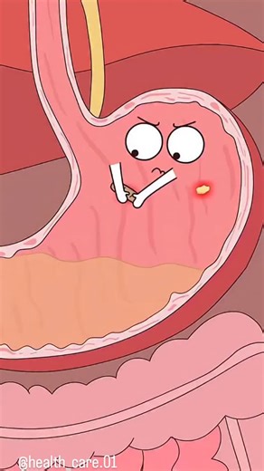 editor...😎🦅 on Instagram: "Brutal Toothache Explained: What Is Pulpitis and Why It Hurts . . Pulpitis is inflammation of the tooth’s nerve from decay, trauma, or cracks. Reversible pulpitis causes short, sharp pain to cold; remove decay and place a restoration to save the pulp. Irreversible pulpitis brings lingering, throbbing pain, often worse when lying down; definitive care is root canal therapy or extraction. Interim relief: OTC pain control (e.g., ibuprofen if appropriate), cold compresse